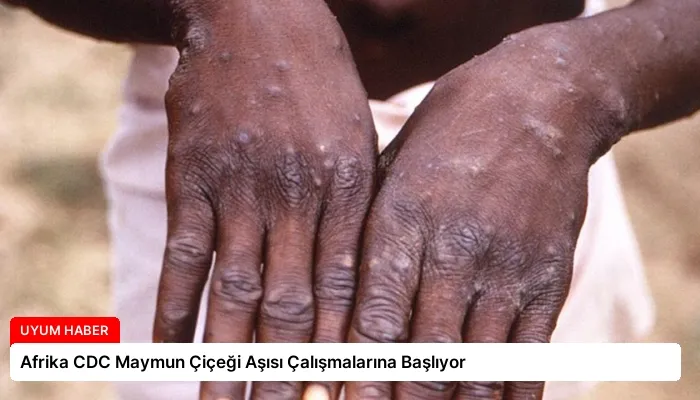 Afrika CDC Maymun Çiçeği Aşısı Çalışmalarına Başlıyor