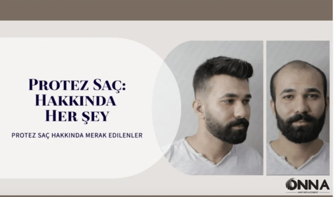 Saç Dökülmesine Kısa Zamanda Uzun Süreli Estetik Çözüm: Protez Saç