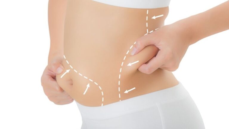 Liposuction Ameliyatı Nedir?