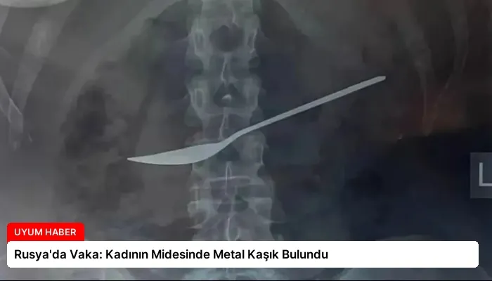 Rusya’da Vaka: Kadının Midesinde Metal Kaşık Bulundu