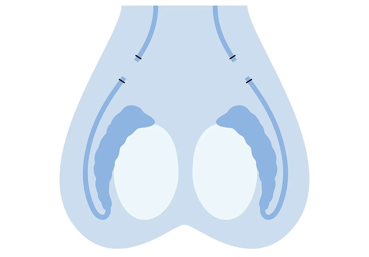 Vazektomi Ameliyatı Nedir?